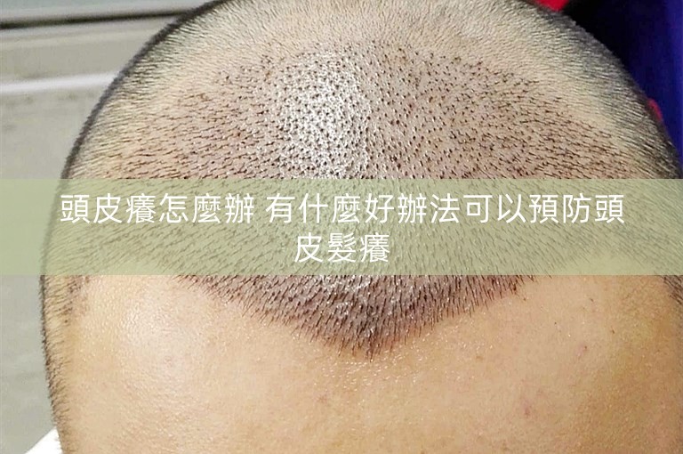 頭皮癢怎麼辦 有什麼好辦法可以預防頭皮髮癢