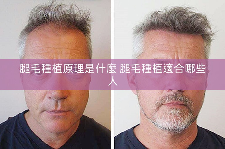 腿毛種植原理是什麼 腿毛種植適合哪些人 腿毛種植原理是什麼 腿毛種植適合哪些人