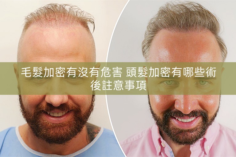 毛髮加密有沒有危害 頭髮加密有哪些術後註意事項