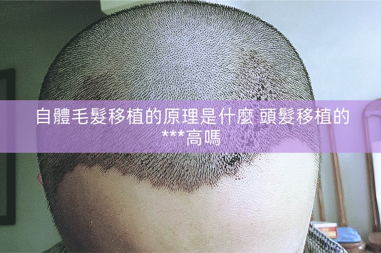 自體毛髮移植的原理是什麼 頭髮移植的***高嗎