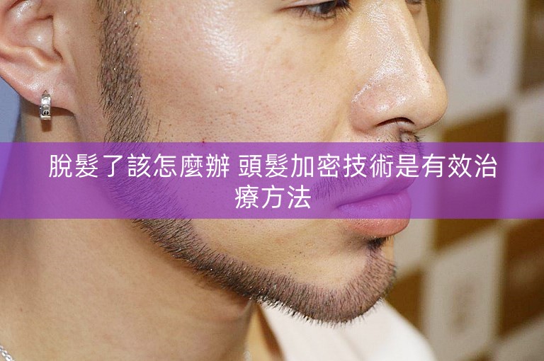 脫髮了該怎麼辦 頭髮加密技術是有效治療方法 脫髮了該怎麼辦 頭髮加密技術是有效治療方法