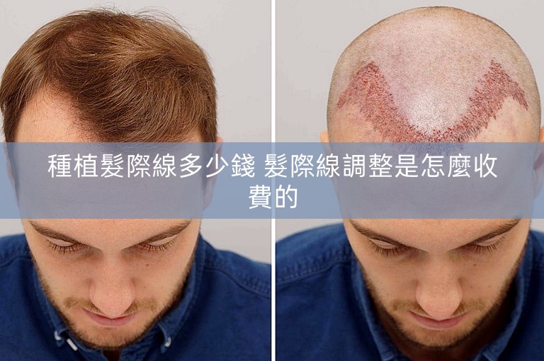 種植髮際線多少錢 髮際線調整是怎麼收費的