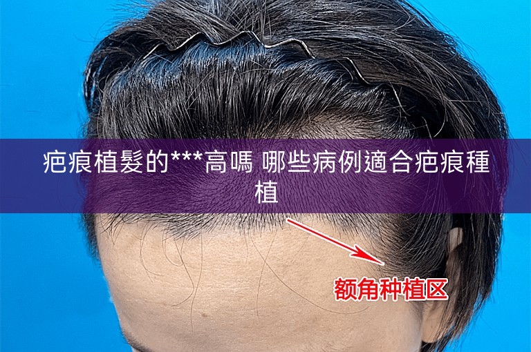 疤痕植髮的***高嗎 哪些病例適合疤痕種植