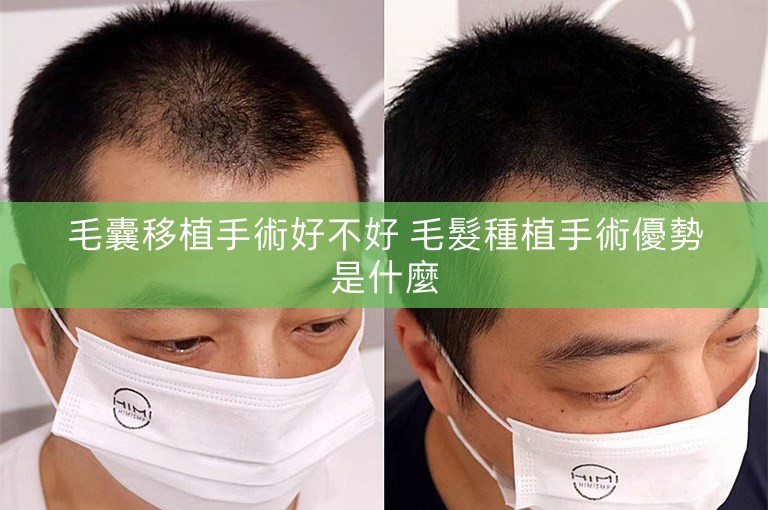 毛囊移植手術好不好 毛髮種植手術優勢是什麼