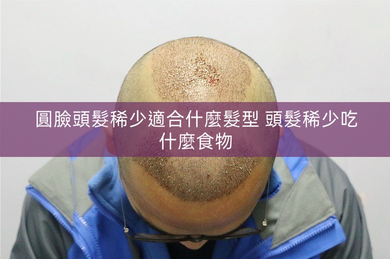 圓臉頭髮稀少適合什麼髮型 頭髮稀少吃什麼食物