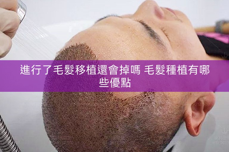 進行了毛髮移植還會掉嗎 毛髮種植有哪些優點