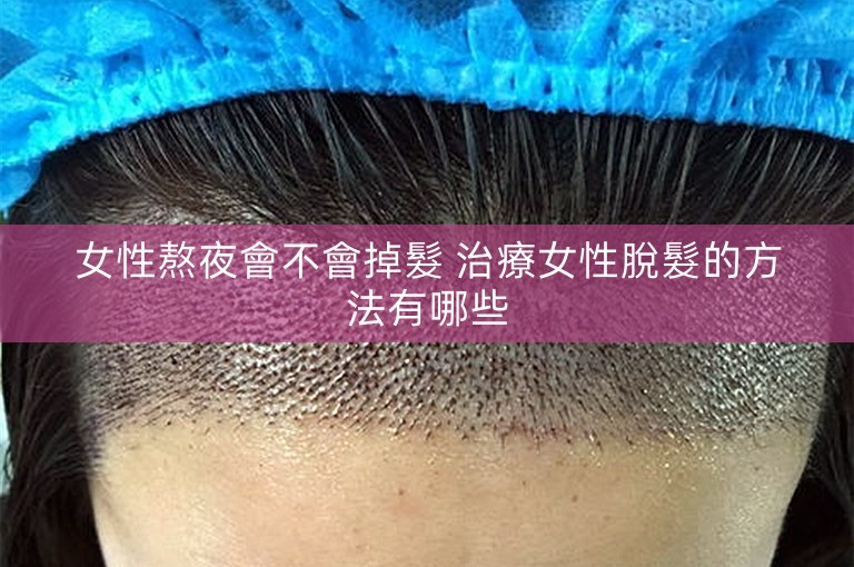 女性熬夜會不會掉髮 治療女性脫髮的方法有哪些