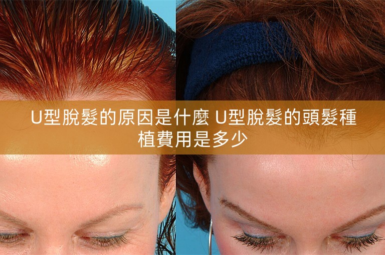 U型脫髮的原因是什麼 U型脫髮的頭髮種植費用是多少