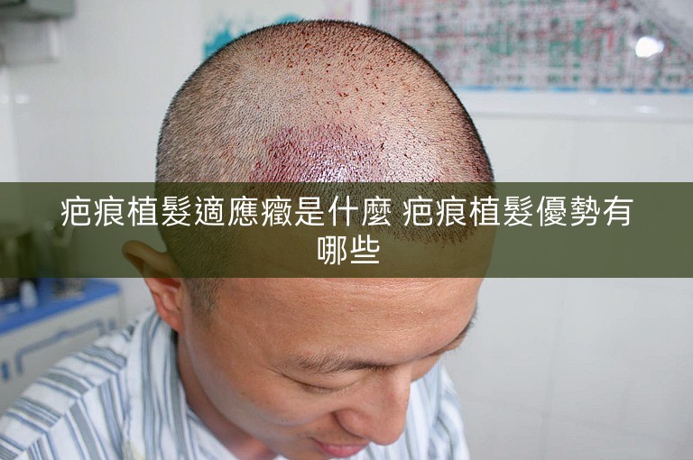疤痕植髮適應癥是什麼 疤痕植髮優勢有哪些