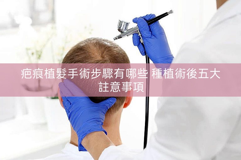 疤痕植髮手術步驟有哪些 種植術後五大註意事項