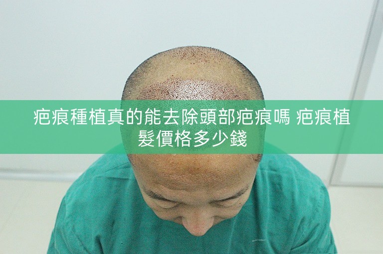 疤痕種植真的能去除頭部疤痕嗎 疤痕植髮價格多少錢