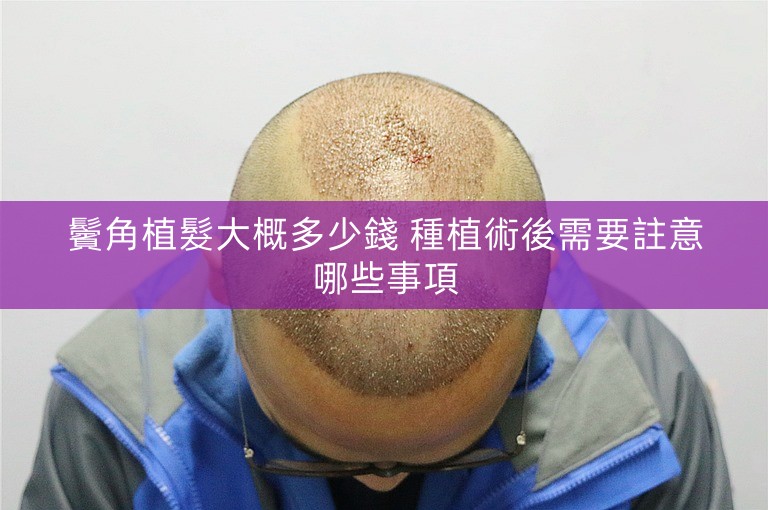 鬢角植髮大概多少錢 種植術後需要註意哪些事項