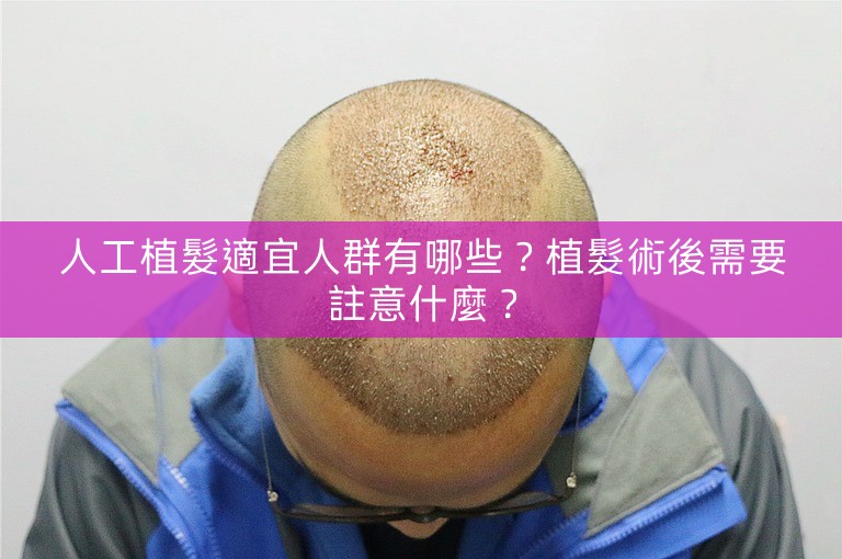 人工植髮適宜人群有哪些?植髮術後需要註意什麼? 人工植髮適宜人群有哪些?植髮術後需要註意什麼?