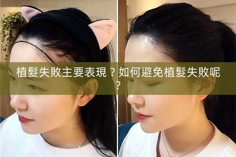 植髮失敗主要表現？如何避免植髮失敗呢?