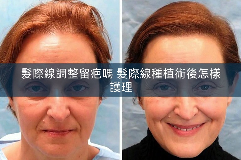 髮際線調整留疤嗎 髮際線種植術後怎樣護理