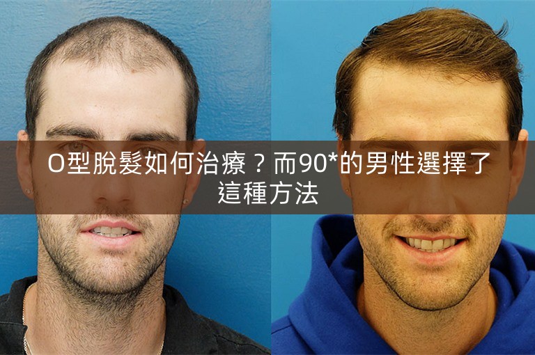 O型脫髮如何治療？而90*的男性選擇了這種方法