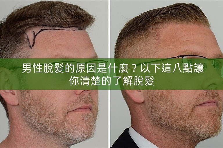  男性脫髮的原因是什麼？以下這八點讓你清楚的了解脫髮