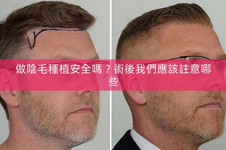 做陰毛種植安全嗎?術後我們應該註意哪些 做陰毛種植安全嗎?術後我們應該註意哪些