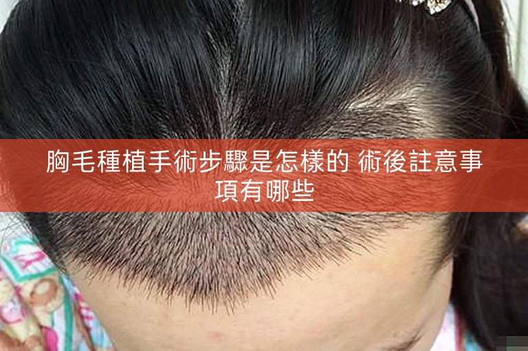 胸毛種植手術步驟是怎樣的 術後註意事項有哪些 胸毛種植手術步驟是怎樣的 術後註意事項有哪些