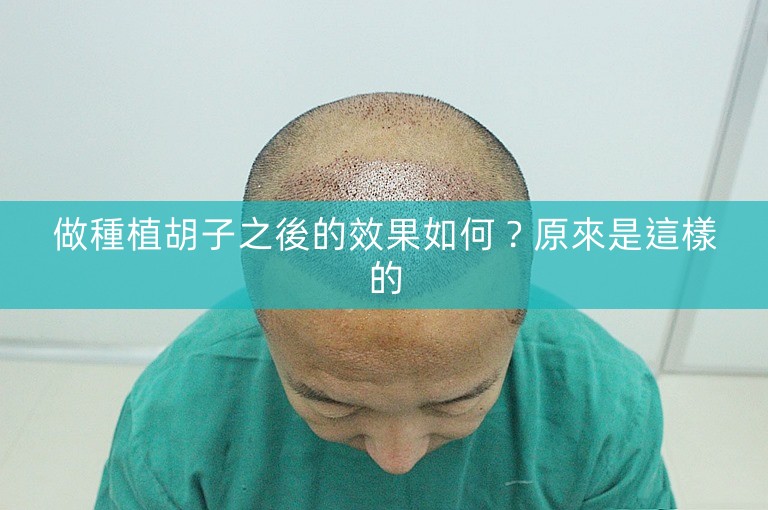 做種植胡子之後的效果如何?原來是這樣的 做種植胡子之後的效果如何?原來是這樣的