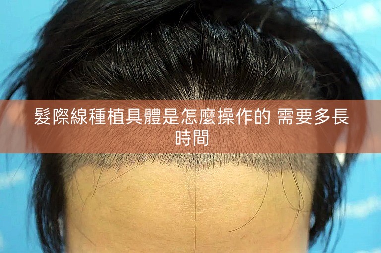 髮際線種植具體是怎麼操作的 需要多長時間