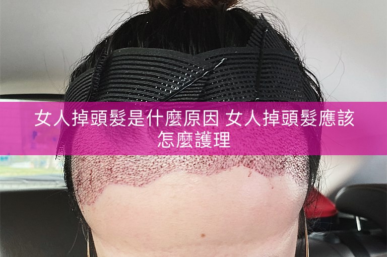 女人掉頭髮是什麼原因 女人掉頭髮應該怎麼護理