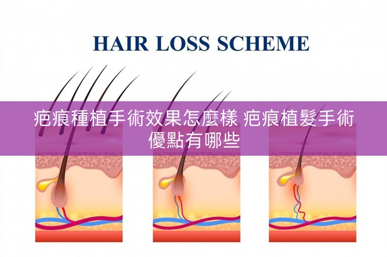 疤痕種植手術效果怎麼樣 疤痕植髮手術優點有哪些 疤痕種植手術效果怎麼樣 疤痕植髮手術優點有哪些