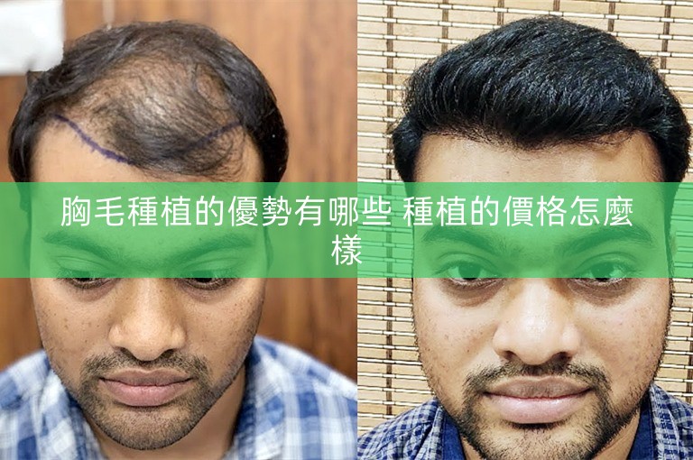 胸毛種植的優勢有哪些 種植的價格怎麼樣