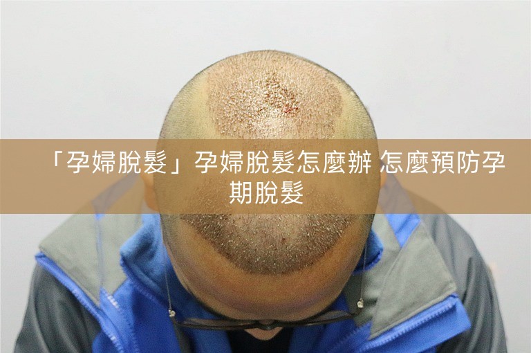 「孕婦脫髮」孕婦脫髮怎麼辦 怎麼預防孕期脫髮