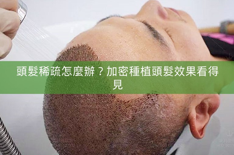 頭髮稀疏怎麼辦？加密種植頭髮效果看得見