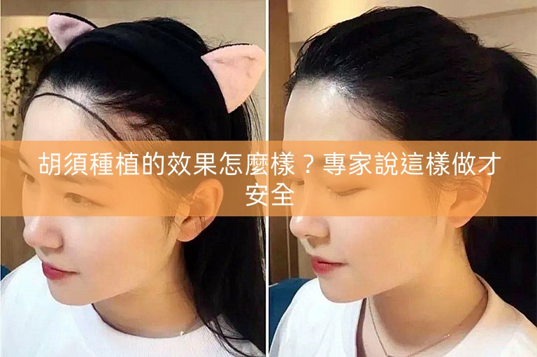 胡須種植的效果怎麼樣?專家說這樣做才安全 胡須種植的效果怎麼樣?專家說這樣做才安全