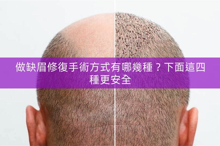 做缺眉修復手術方式有哪幾種?下面這四種更安全 做缺眉修復手術方式有哪幾種?下面這四種更安全