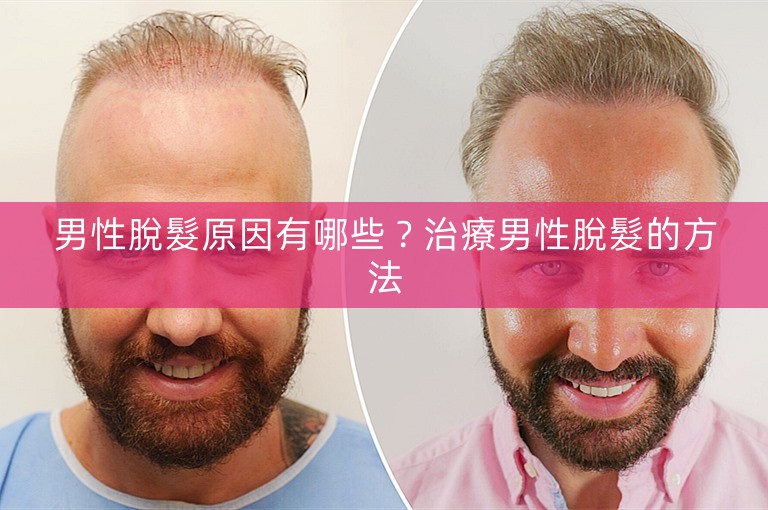 男性脫髮原因有哪些?治療男性脫髮的方法 男性脫髮原因有哪些?治療男性脫髮的方法