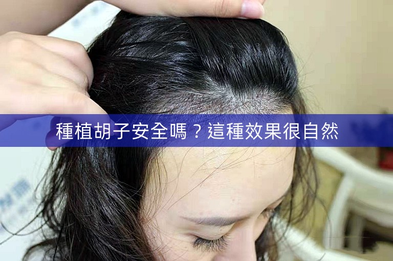 種植胡子安全嗎?這種效果很自然 種植胡子安全嗎?這種效果很自然