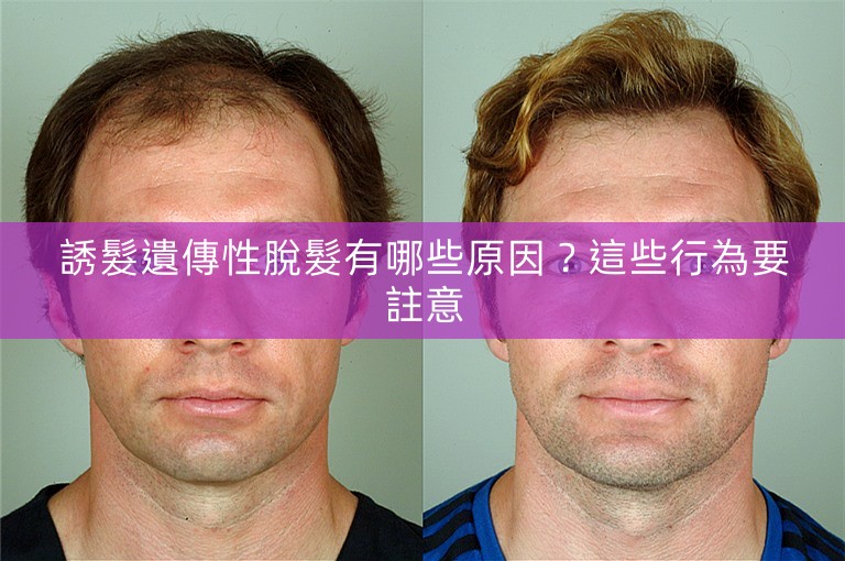 誘髮遺傳性脫髮有哪些原因？這些行為要註意