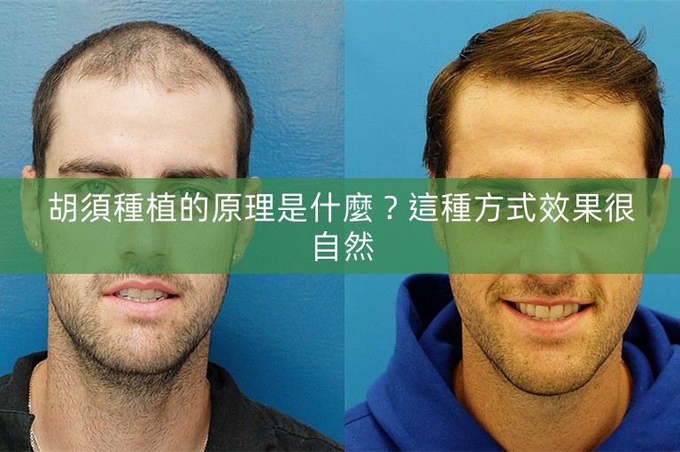 胡須種植的原理是什麼?這種方式效果很自然 胡須種植的原理是什麼?這種方式效果很自然