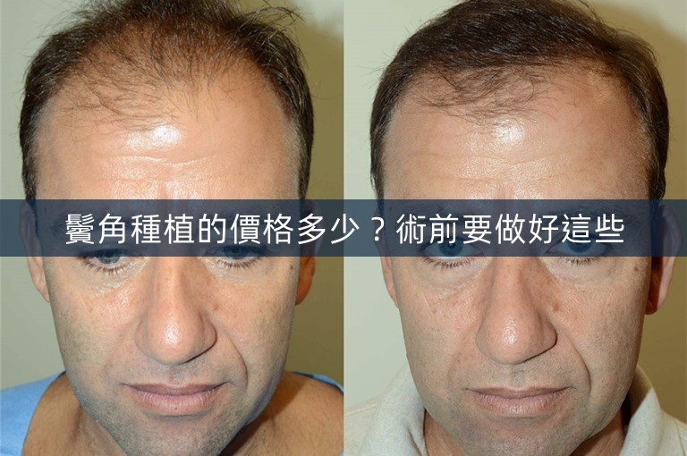 鬢角種植的價格多少？術前要做好這些