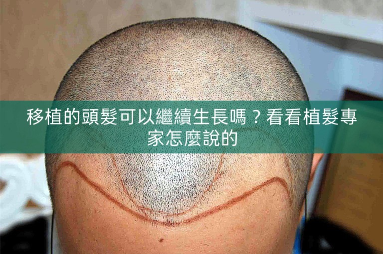 移植的頭髮可以繼續生長嗎？看看植髮專家怎麼說的