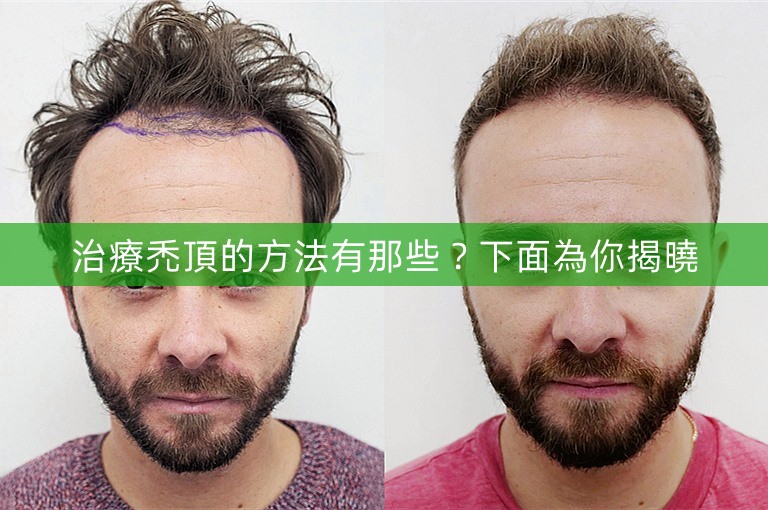 治療禿頂的方法有那些？下面為你揭曉