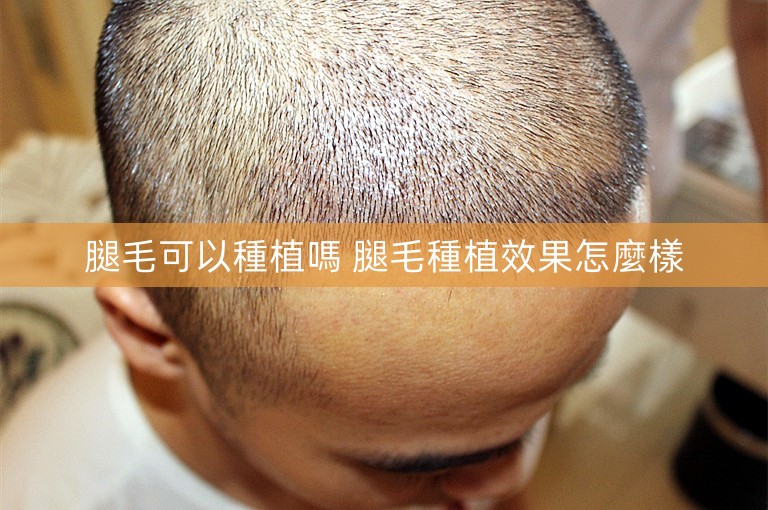 腿毛可以種植嗎 腿毛種植效果怎麼樣