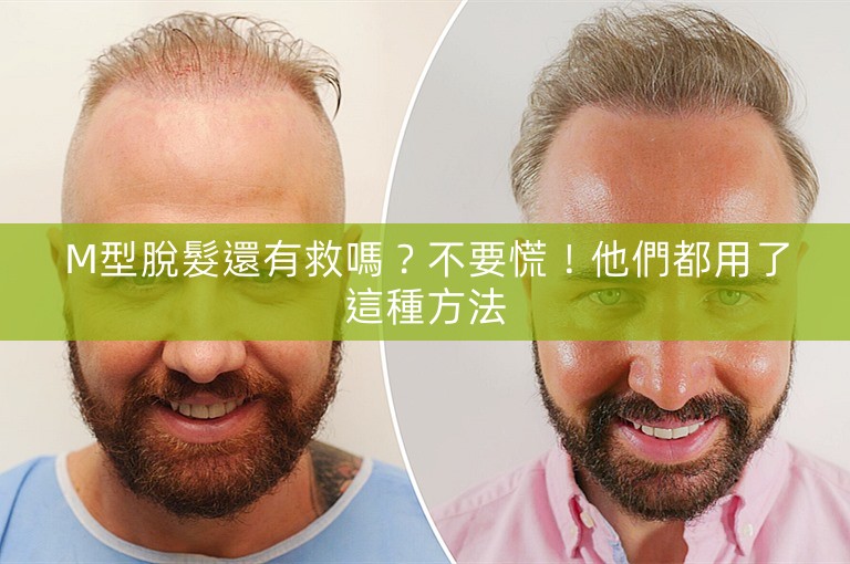 M型脫髮還有救嗎?不要慌!他們都用了這種方法 M型脫髮還有救嗎?不要慌!他們都用了這種方法