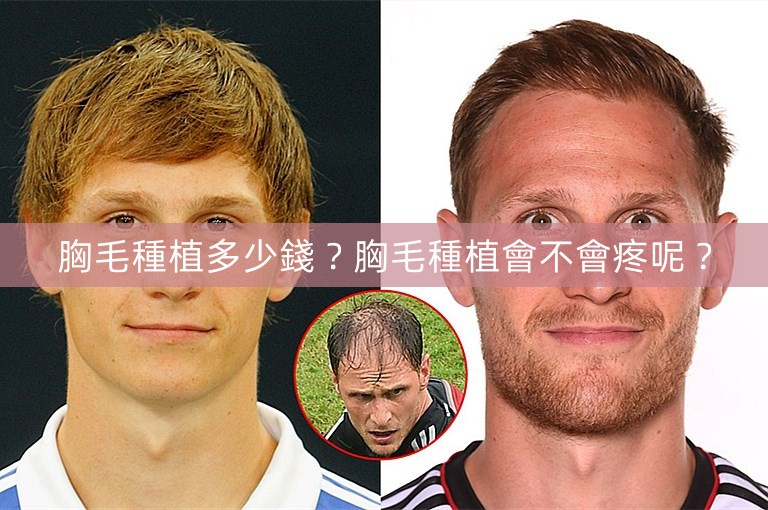 胸毛種植多少錢?胸毛種植會不會疼呢? 胸毛種植多少錢?胸毛種植會不會疼呢?