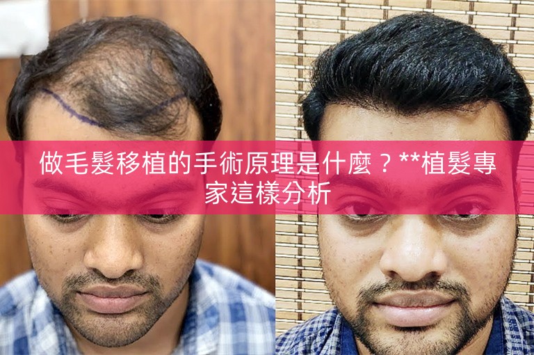 做毛髮移植的手術原理是什麼？**植髮專家這樣分析
