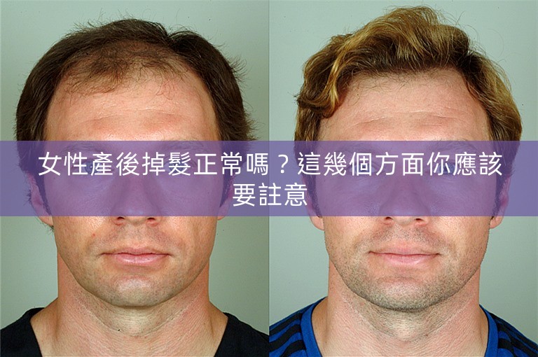 女性產後掉髮正常嗎？這幾個方面你應該要註意