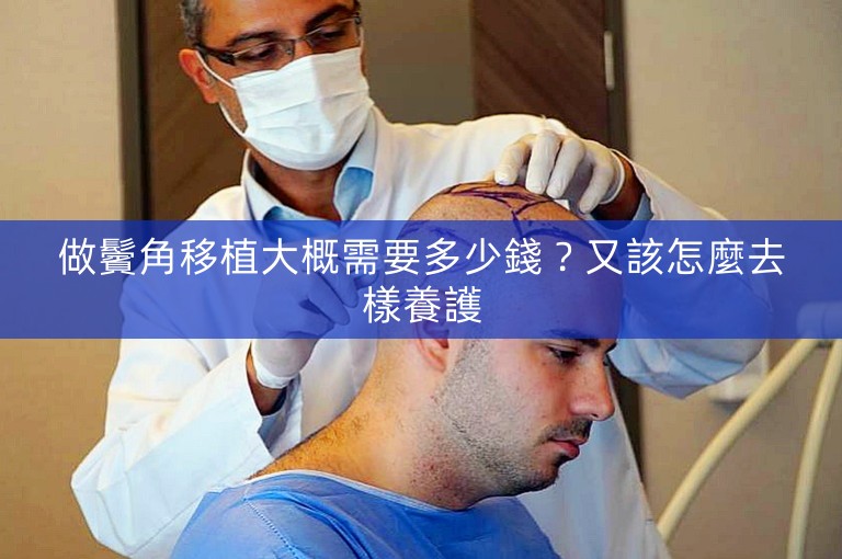 做鬢角移植大概需要多少錢？又該怎麼去樣養護