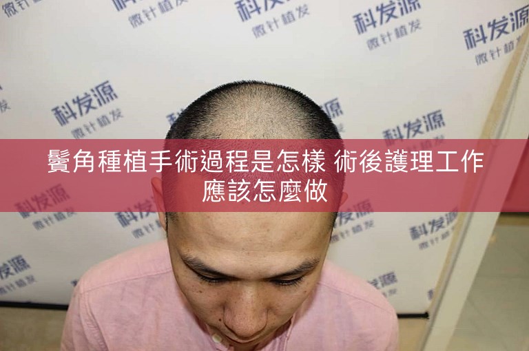 鬢角種植手術過程是怎樣 術後護理工作應該怎麼做