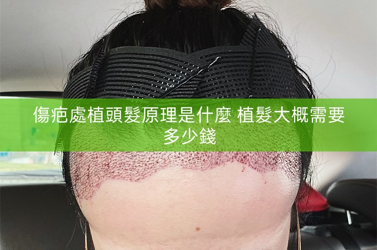 傷疤處植頭髮原理是什麼 植髮大概需要多少錢