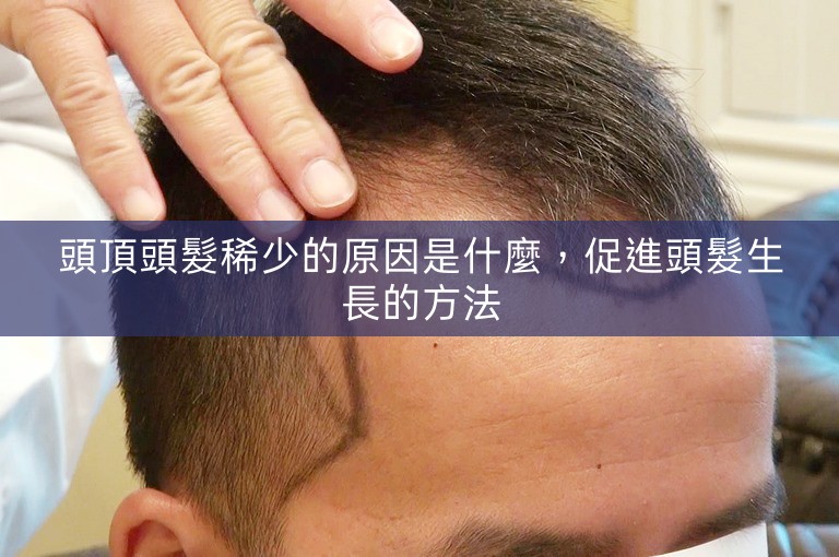 頭頂頭髮稀少的原因是什麼，促進頭髮生長的方法