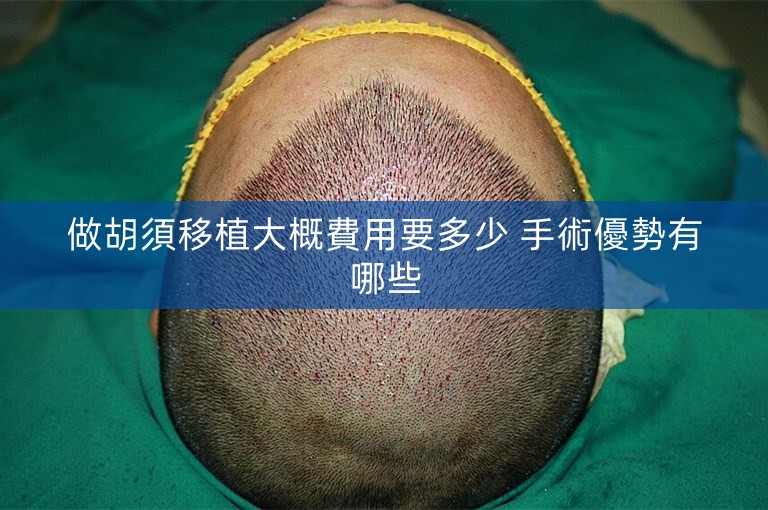 做胡須移植大概費用要多少 手術優勢有哪些 做胡須移植大概費用要多少 手術優勢有哪些