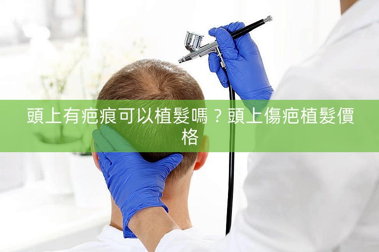 頭上有疤痕可以植髮嗎？頭上傷疤植髮價格